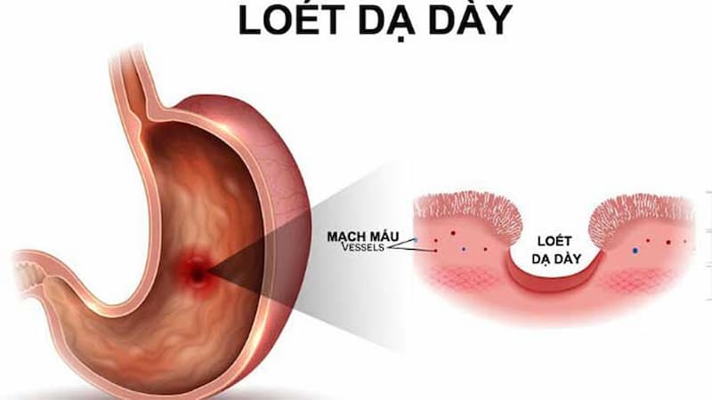 viêm loét dạ dày