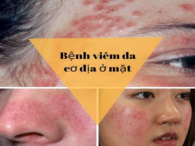 Về bệnh viêm da cơ địa