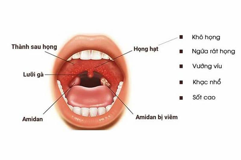 Dấu hiệu viêm họng ở trẻ em