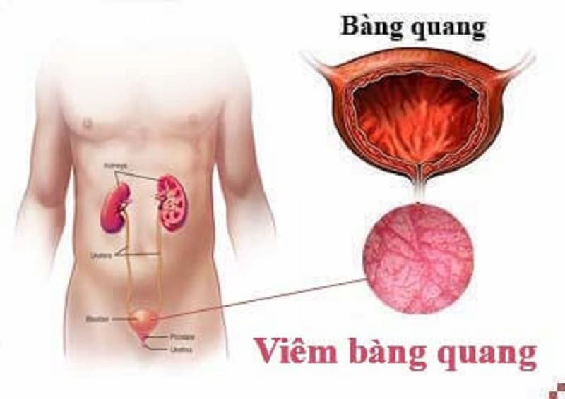 viêm bàng quang