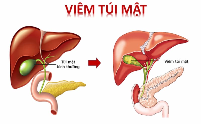 Định nghĩa rõ hơn về viêm túi mật