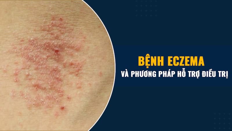 bệnh viêm da eczema